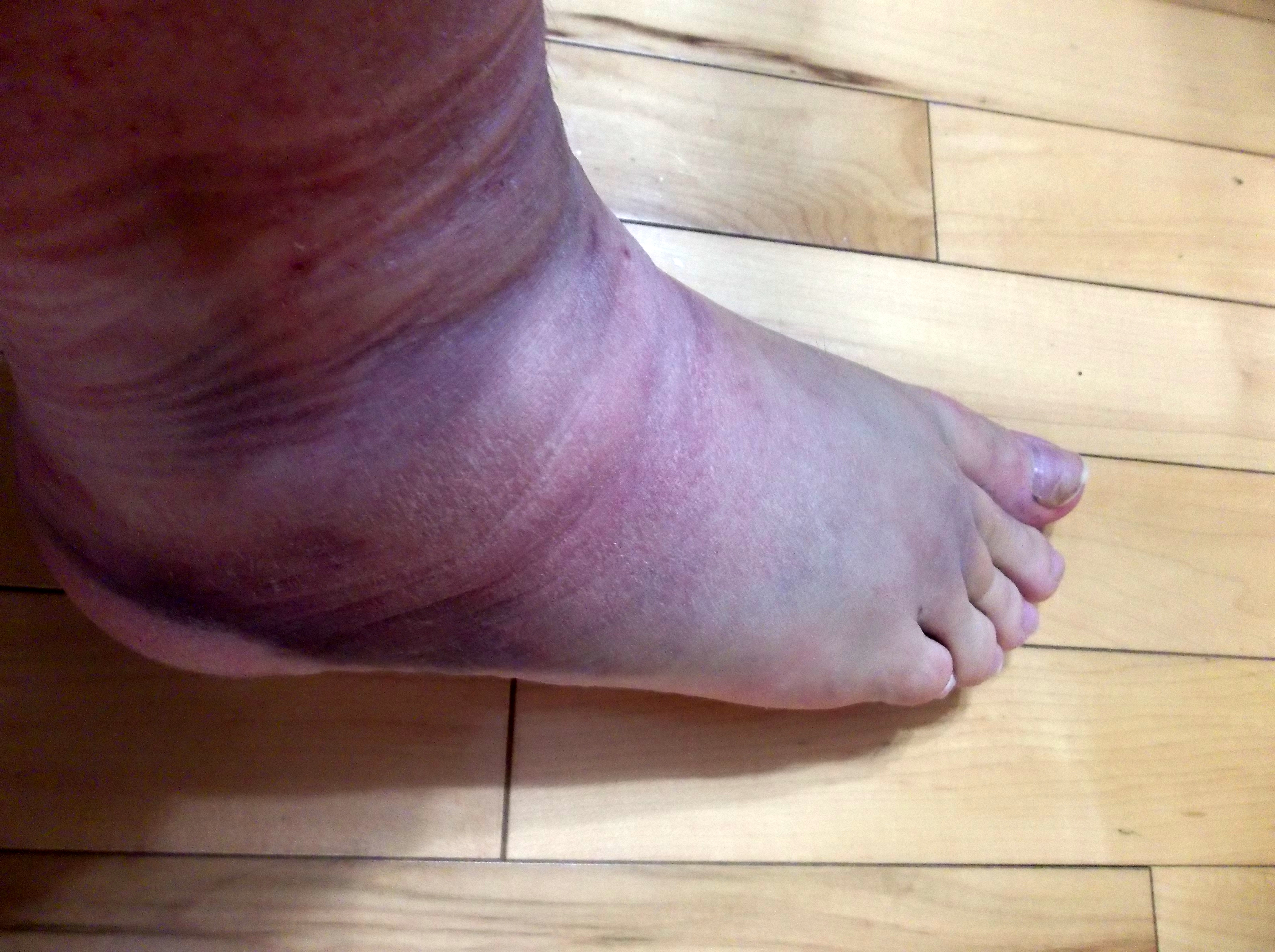 Can Swollen Legs & Feet Leave Feet Bruised 116